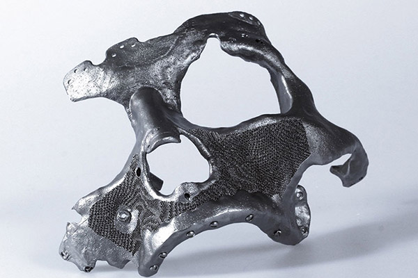 3D metal printed prosthetic facial bone implant